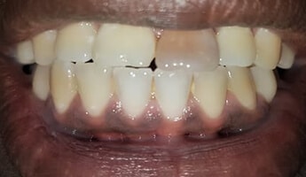 הלבנת שיניים